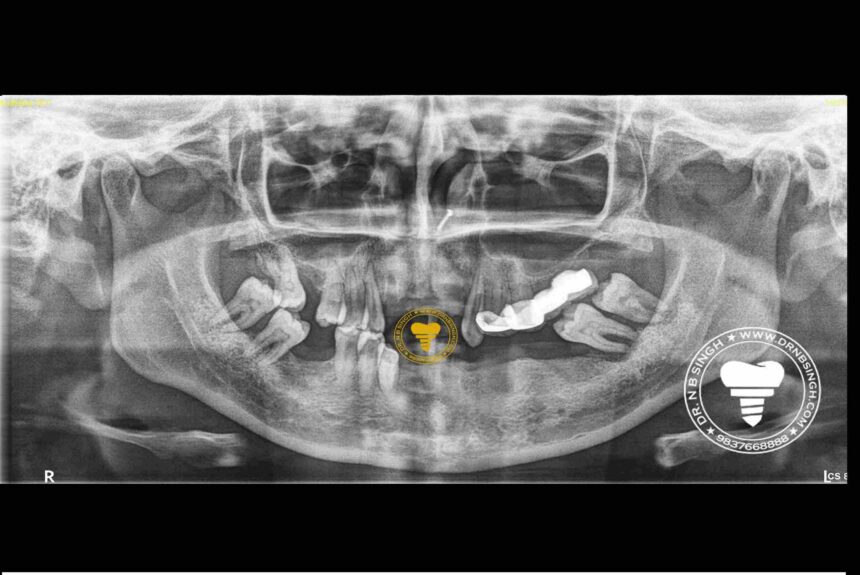 2 Rubina- post operative opg of basal implants- Dr N B Singh