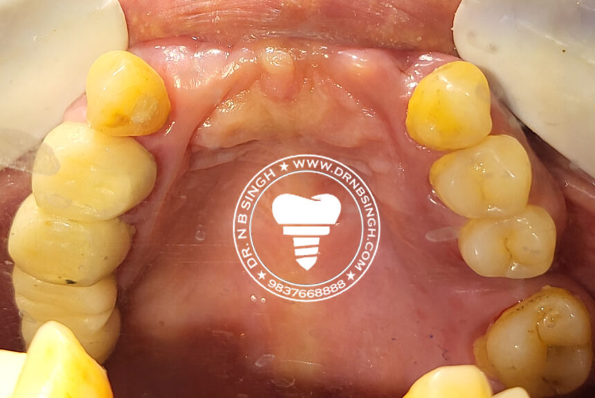 Rubina case 3 basal implant full mouth rehabilitation